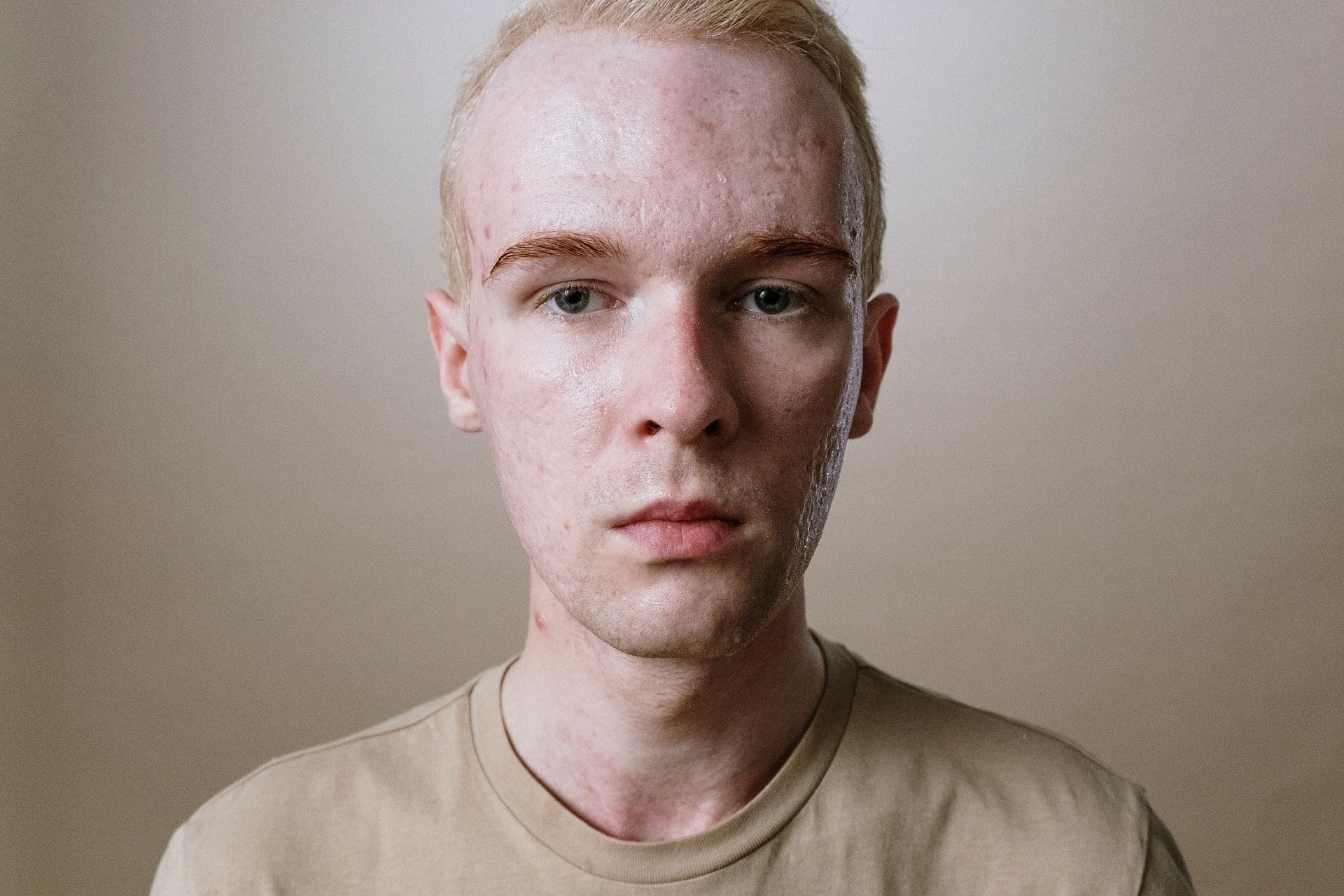 Manuka honey benefits for skin include treating and preventing acne. (Photo via Pexels/cottonbro studio)
